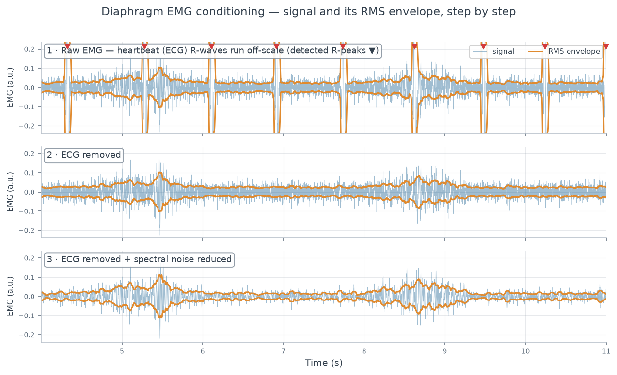 Three stacked EMG traces of the same breath: the raw signal with large periodic cardiac spikes, the ECG-removed signal with those spikes flattened, and the noise-reduced signal with a cleaner baseline and the inspiratory EMG burst preserved.