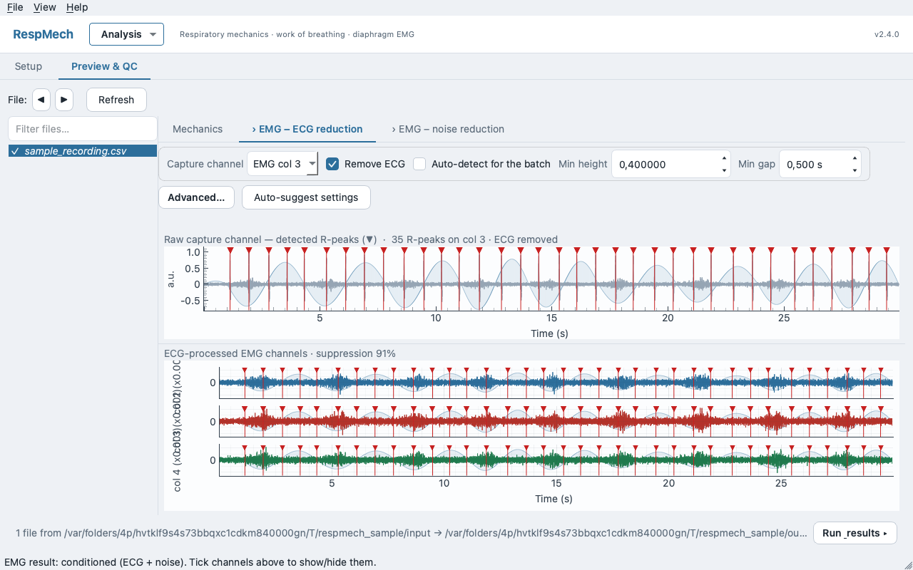 Preview EMG ECG-reduction tab: capture-channel picker, Remove ECG toggle, Min height and Min gap fields, Auto-suggest button, and the capture channel showing detected R-peak markers with the ECG-removed channels below