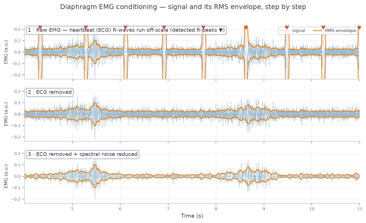Three-panel diaphragm EMG conditioning: raw EMG with off-scale ECG R-waves, then ECG removed, then ECG removed plus spectral noise reduced, each with its RMS envelope overlaid.